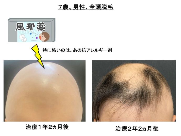 円形脱毛症　病院